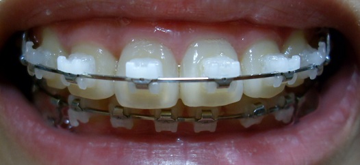 오라픽스 치아교정 포스팅(6).JPG