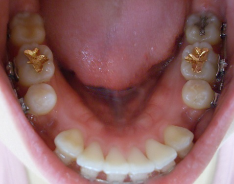 오라픽스 치아교정 포스팅(5).JPG