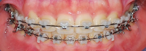 오라픽스 치아교정 포스팅 (5).jpg