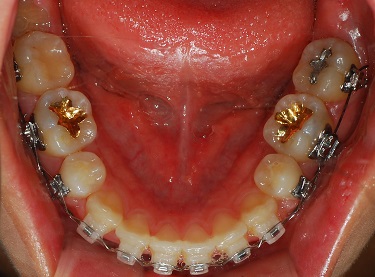 오라픽스 치아교정 포스팅 (8).jpg