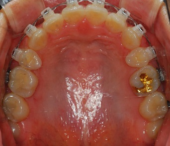 오라픽스 치아교정 포스팅 (7).jpg
