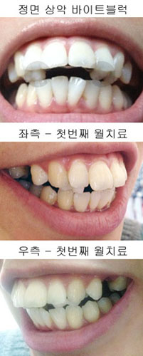 치아교정후기2.jpg