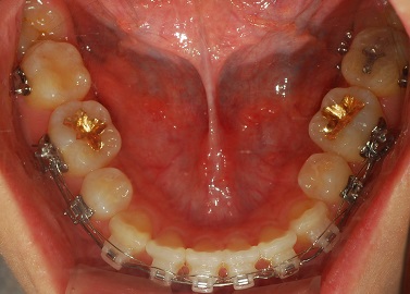 오라픽스 치아교정 포스팅 (10).JPG