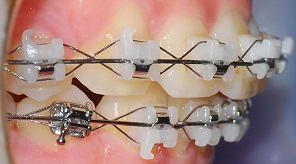 오라픽스 치아교정 포스팅 (7).JPG