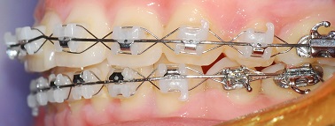 오라픽스 치아교정 포스팅 (8).JPG