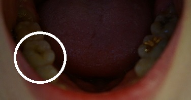 오라픽스 치아교정 포스팅 (5).jpg