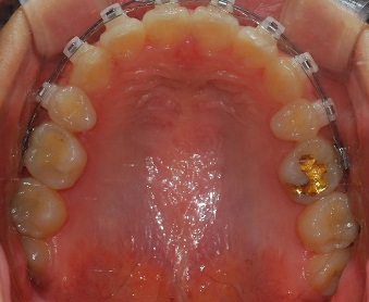오라픽스 치아교정 포스팅 (9).JPG