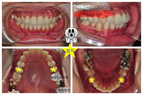 치아교정후기2.jpg