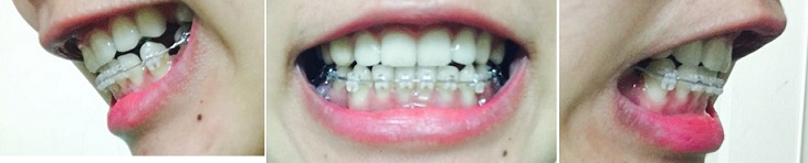 교정후기 25_1.JPG