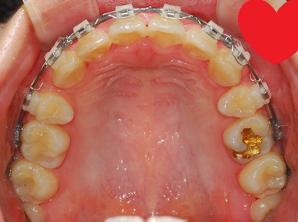 오라픽스 치아교정 포스팅 (9).jpg