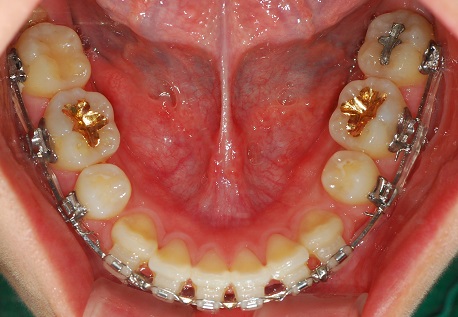 오라픽스 치아교정 포스팅 (10).jpg