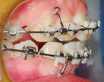 오라픽스 치아교정 포스팅 (8).jpg