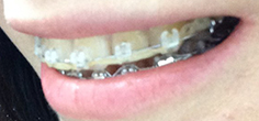치아교정후기1.jpg