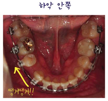 치아교정후기05.jpg