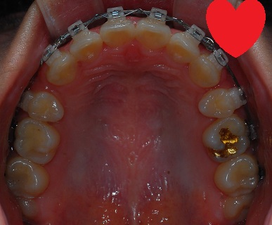 오라픽스 치아교정 포스팅(6).jpg