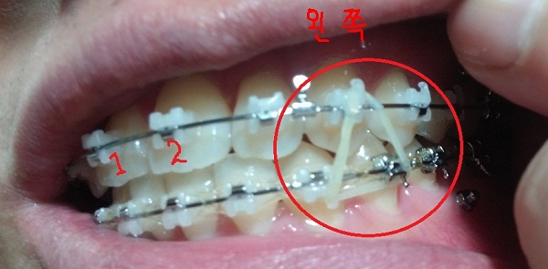 턱관절치아교정후기25화사진8.jpg