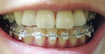 치아교정후기1.jpg