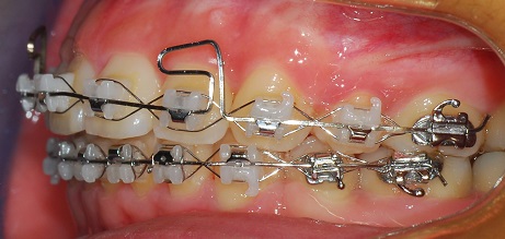 오라픽스 치아교정 포스팅(2).jpg