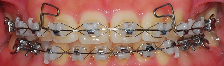 오라픽스 치아교정 포스팅(1).jpg