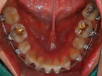오라픽스 치아교정 포스팅 (10).jpg
