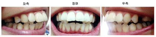 치아교정후기1.jpg