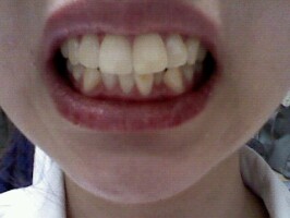 치아사진1.jpg