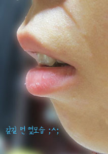 치아교정후기01.JPG