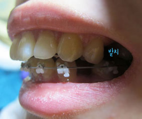 치아교정후기03.JPG