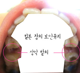 치아교정후기08.JPG