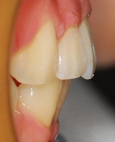 오라픽스 치아교정 포스팅(5).jpg