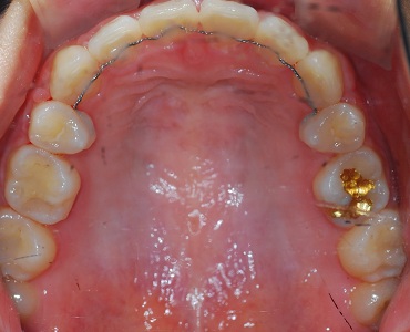 오라픽스 치아교정 포스팅(7).jpg