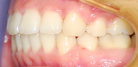 오라픽스 치아교정 포스팅(6).jpg