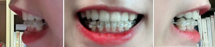 교정후기 26_1.jpg