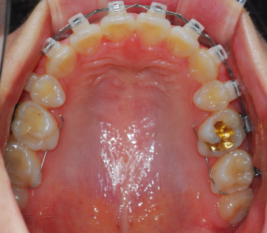 오라픽스 치아교정 포스팅 (4).png