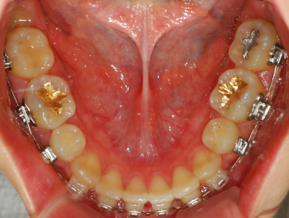 오라픽스 치아교정 포스팅 (5).png