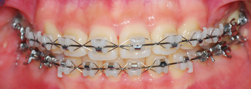 오라픽스 치아교정 포스팅 (3).png