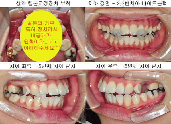 치아교정후기1.jpg