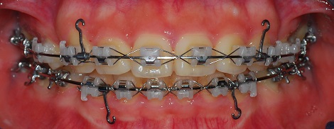 오라픽스 치아교정 포스팅(9).jpg