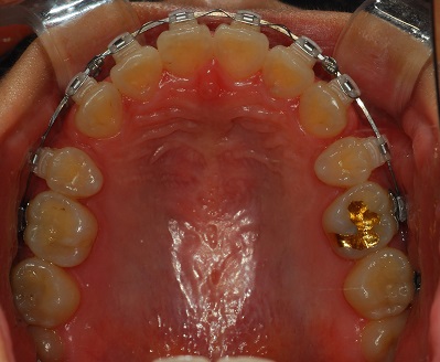 오라픽스 치아교정 포스팅(2).jpg