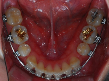 오라픽스 치아교정 포스팅(3).jpg